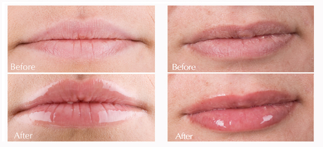 before-after-lip-plumper.jpg before-after-lip-plumper.jpg